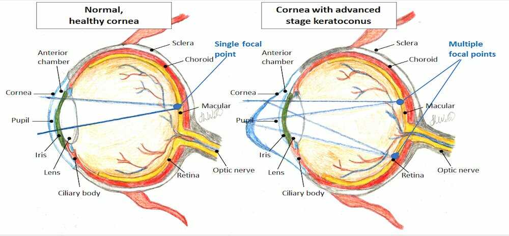 Diagram healthy refraction and unhealthy refraction