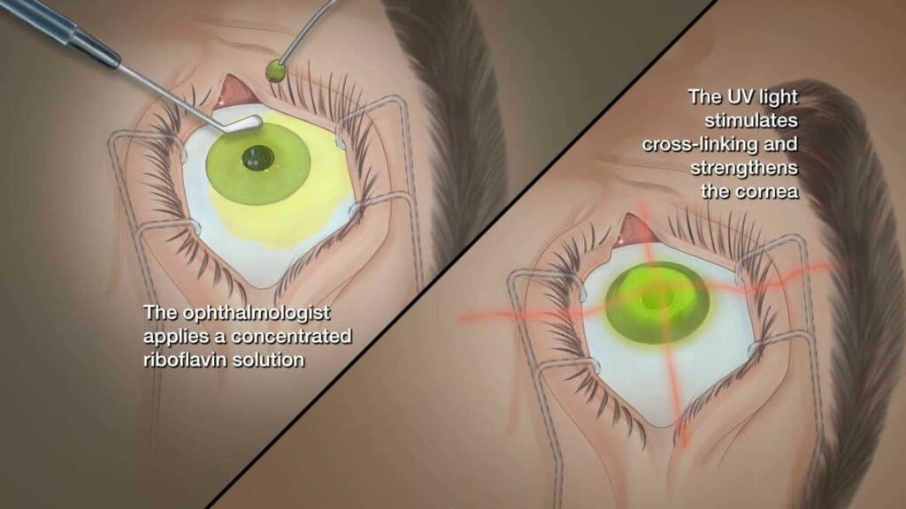 image of corneal cross linking