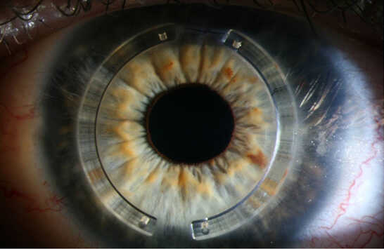 image_corneal_ring