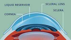 image of how scleral contact lenses for keratoconus sit on eye lens works